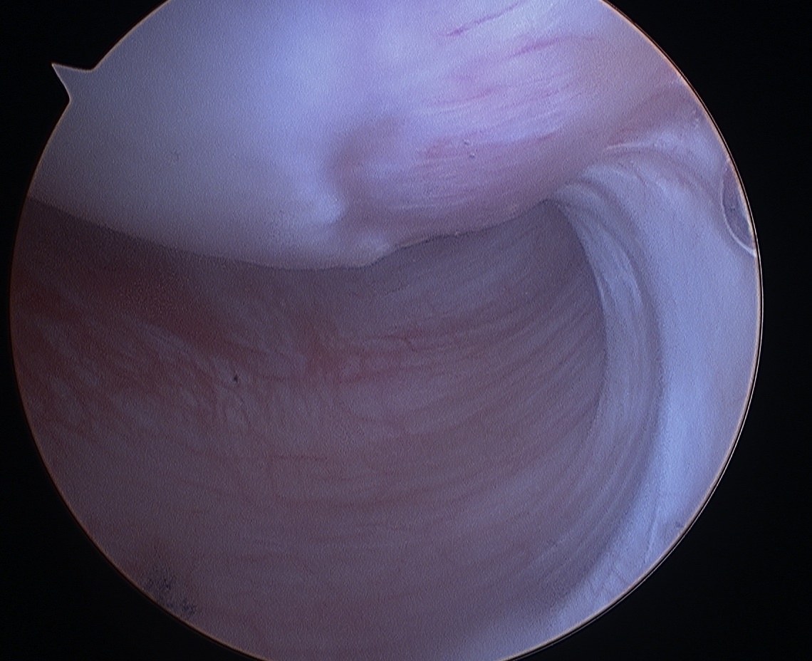 Normal IGHL Humeral Attachment